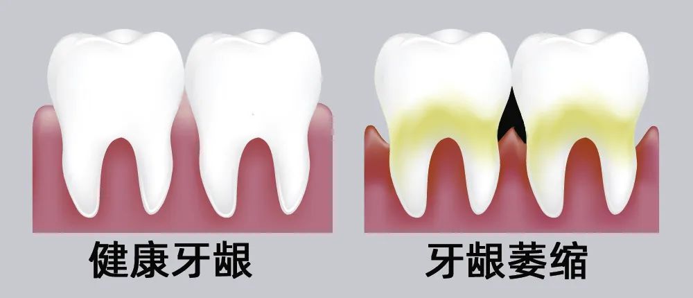 牙縫大露出“黑三角”，既塞牙又難看！還能恢復(fù)嗎？