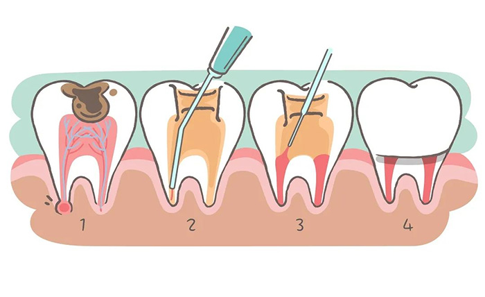 細(xì)說根管治療，聽聽專家怎么講...